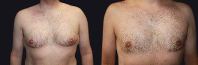 Male Liposuction Before & After Gallery - Patient 177905977 - Image 1