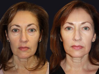 Laser Skin Rejuvenation Before & After Gallery - Patient 177905979 - Image 1