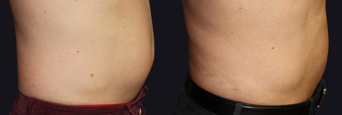 Male Liposuction Before & After Gallery - Patient 177905975 - Image 2