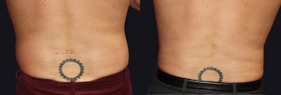 Male Liposuction Before & After Gallery - Patient 177905975 - Image 1