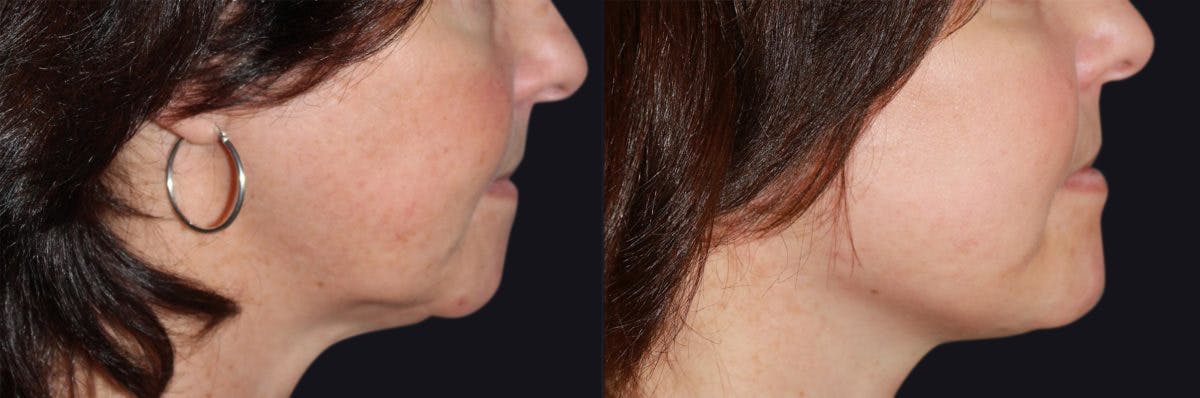 Laser Skin Rejuvenation Before & After Gallery - Patient 177905972 - Image 2
