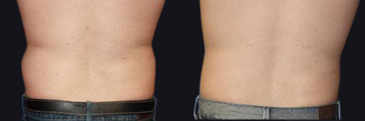 Male Liposuction Before & After Gallery - Patient 177905971 - Image 2