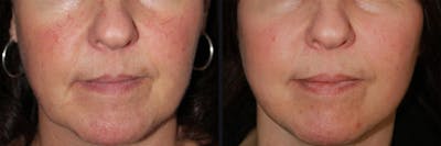 Laser Skin Rejuvenation Before & After Gallery - Patient 177905972 - Image 1