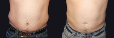 Male Liposuction Before & After Gallery - Patient 177905971 - Image 1
