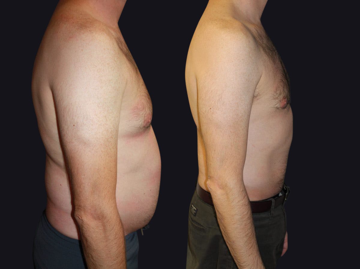 Male Liposuction Before & After Gallery - Patient 177905967 - Image 2