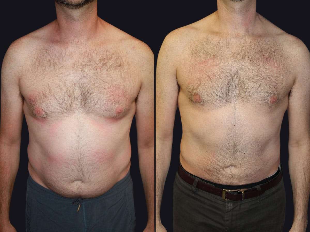 Male Liposuction Before & After Gallery - Patient 177905967 - Image 1