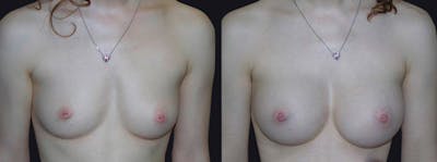 Breast Augmentation Before & After Gallery - Patient 177905965 - Image 1