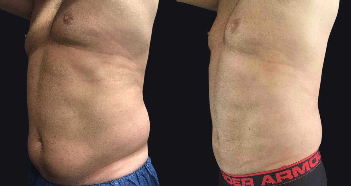 Male Liposuction Before & After Gallery - Patient 177905963 - Image 3