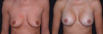 Breast Augmentation Before & After Gallery - Patient 177905962 - Image 1