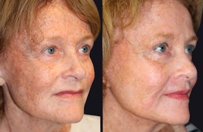 Clear & Brilliant (Fraxel) Before & After Gallery - Patient 177905961 - Image 1