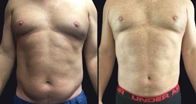 Male Liposuction Before & After Gallery - Patient 177905963 - Image 1