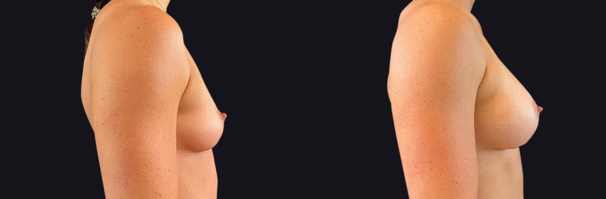 Breast Augmentation Before & After Gallery - Patient 177905960 - Image 2