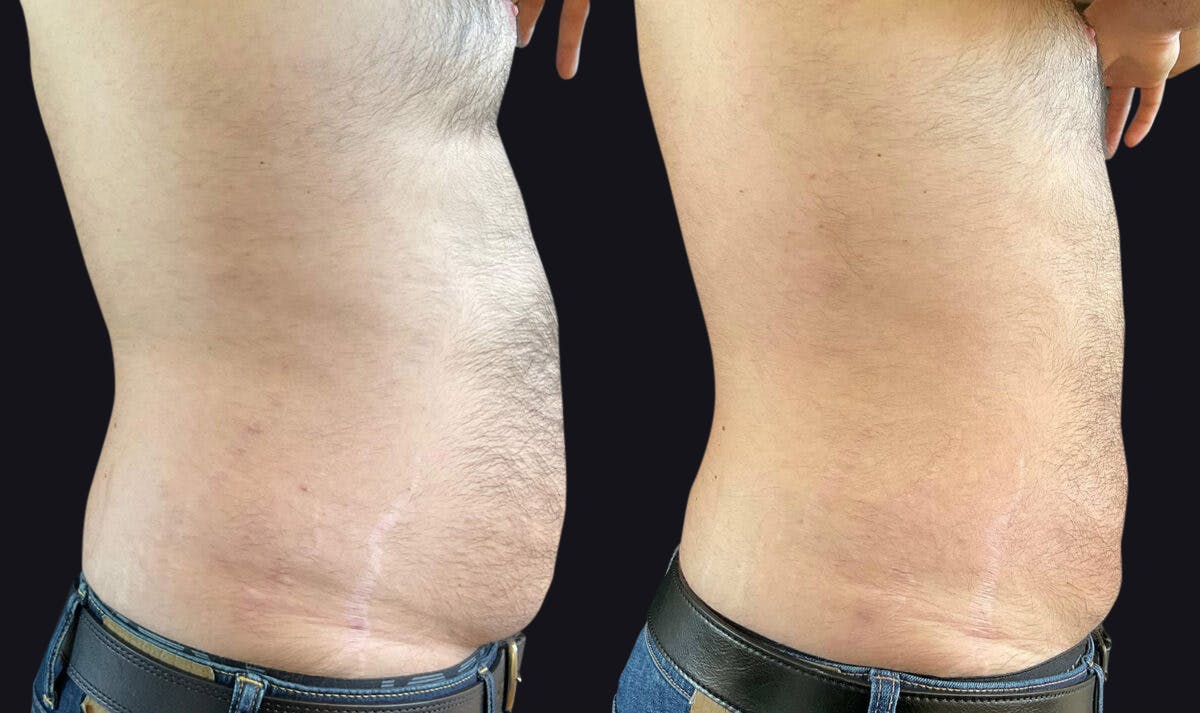 Male Liposuction Before & After Gallery - Patient 177905959 - Image 3