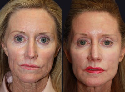 Clear & Brilliant (Fraxel) Before & After Gallery - Patient 177905958 - Image 1