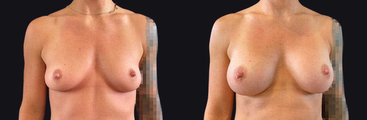 Breast Augmentation Before & After Gallery - Patient 177905960 - Image 1