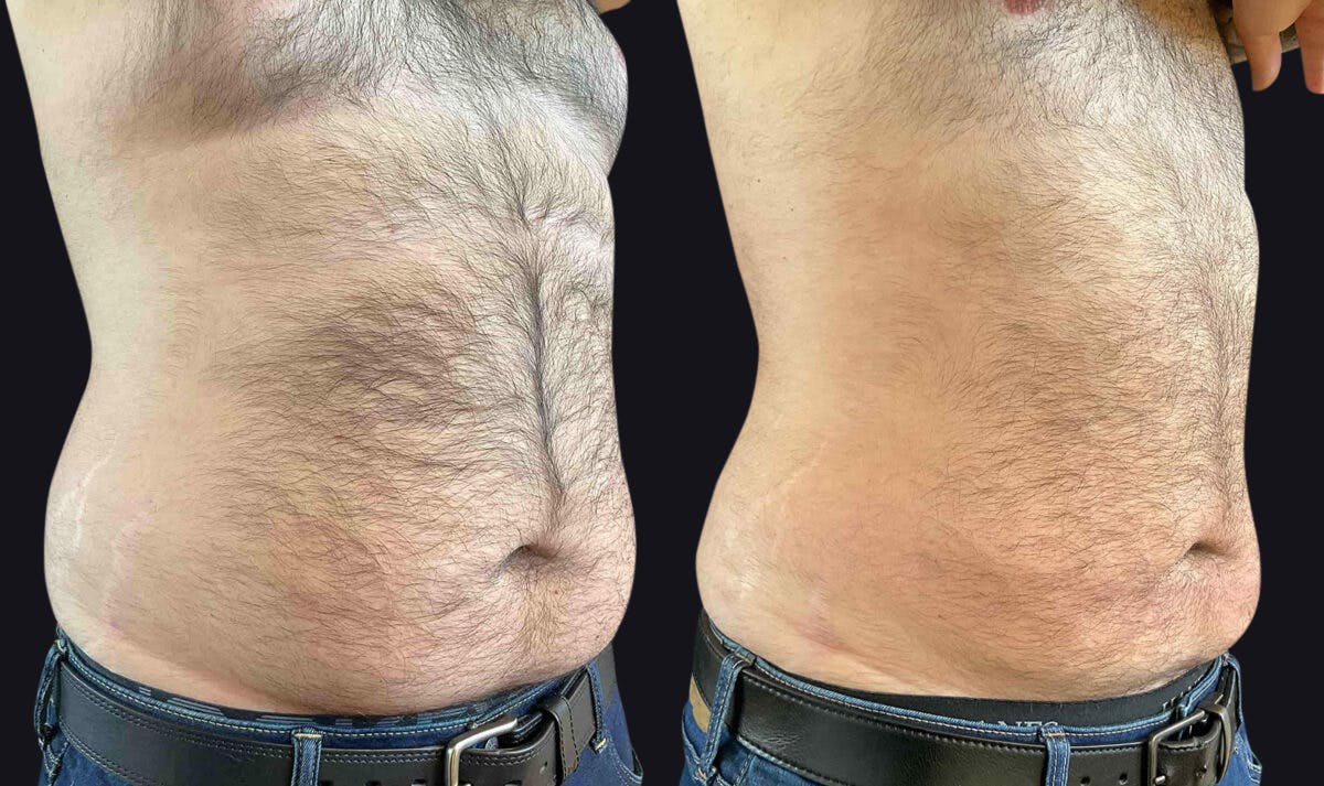 Male Liposuction Before & After Gallery - Patient 177905959 - Image 2