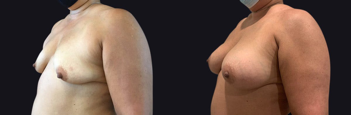 Breast Augmentation Before & After Gallery - Patient 177905951 - Image 3