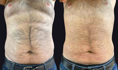 Male Liposuction Before & After Gallery - Patient 177905959 - Image 1