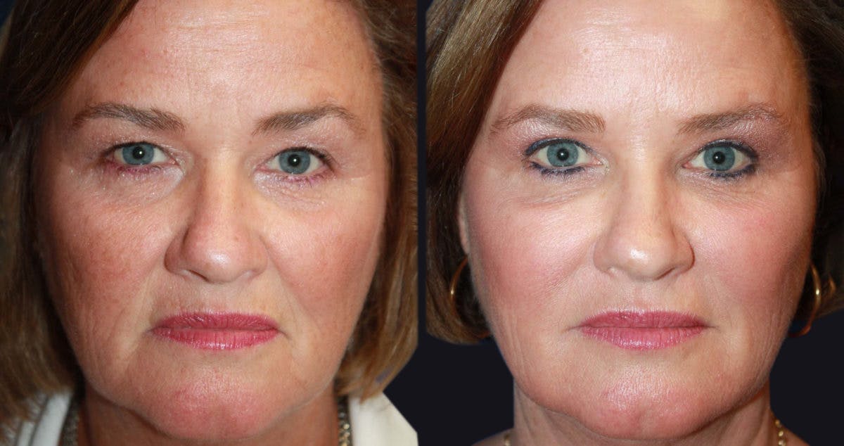 Clear & Brilliant (Fraxel) Before & After Gallery - Patient 177905949 - Image 1