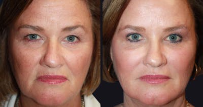 Clear & Brilliant (Fraxel) Before & After Gallery - Patient 177905949 - Image 1