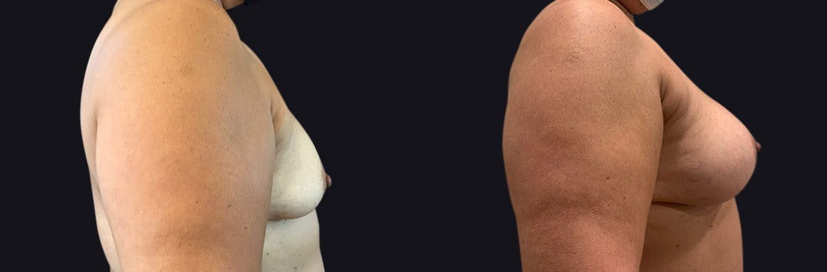 Breast Augmentation Before & After Gallery - Patient 177905951 - Image 2