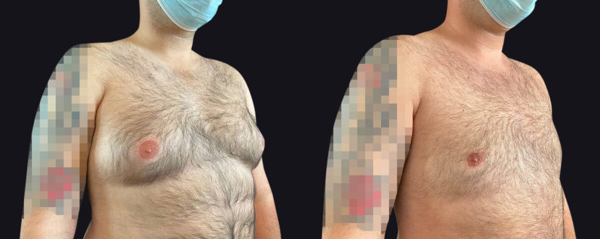 Male Breast Reduction Before & After Gallery - Patient 177905950 - Image 2