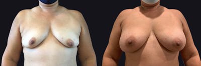 Breast Augmentation Before & After Gallery - Patient 177905951 - Image 1