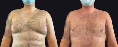 Male Breast Reduction Before & After Gallery - Patient 177905950 - Image 1