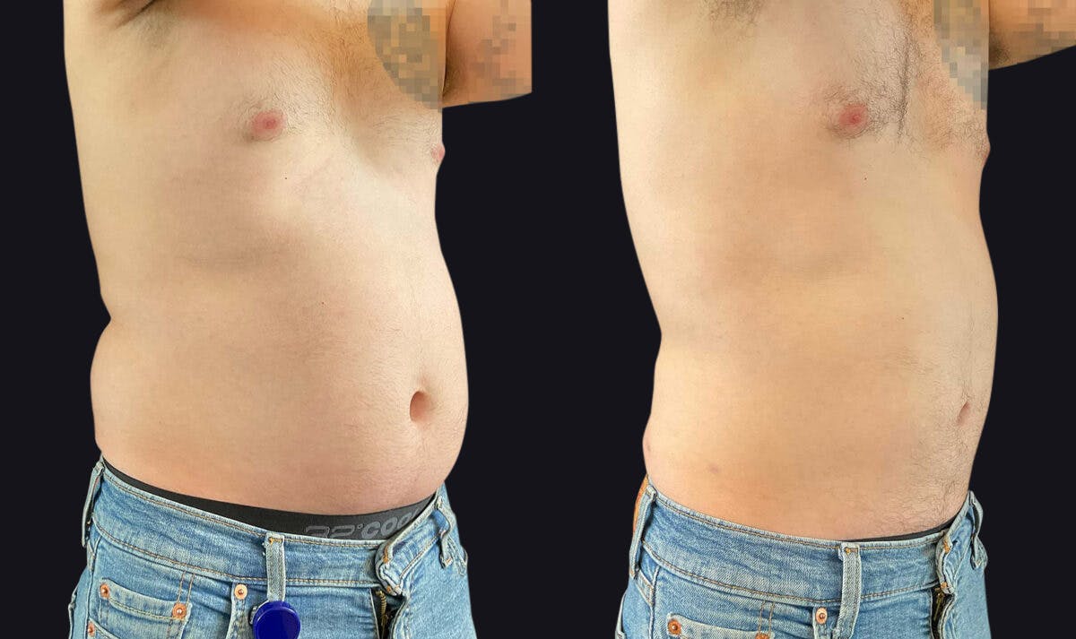 Male Liposuction Before & After Gallery - Patient 177905948 - Image 2