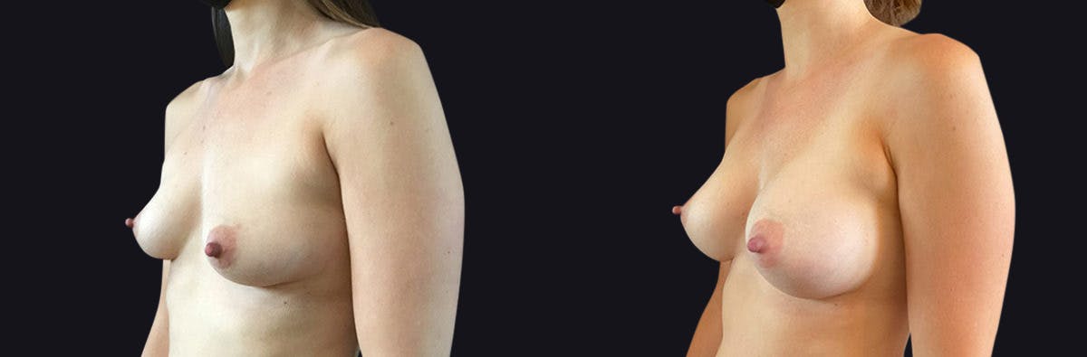 Breast Augmentation Before & After Gallery - Patient 177905944 - Image 3