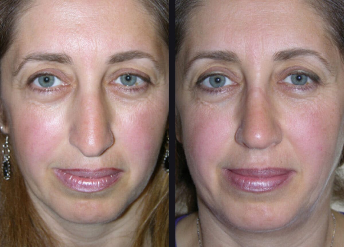 Rhinoplasty Before & After Gallery - Patient 177905938 - Image 2