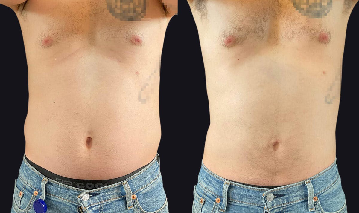 Male Liposuction Before & After Gallery - Patient 177905948 - Image 1