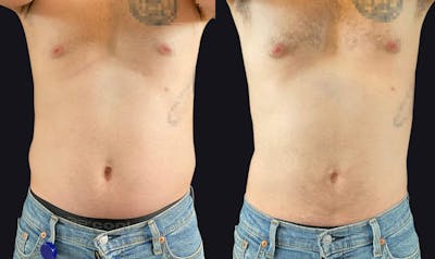 Male Liposuction Before & After Gallery - Patient 177905948 - Image 1