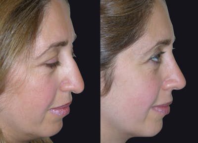 Rhinoplasty Before & After Gallery - Patient 177905938 - Image 1