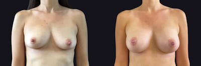 Breast Augmentation Before & After Gallery - Patient 177905944 - Image 1