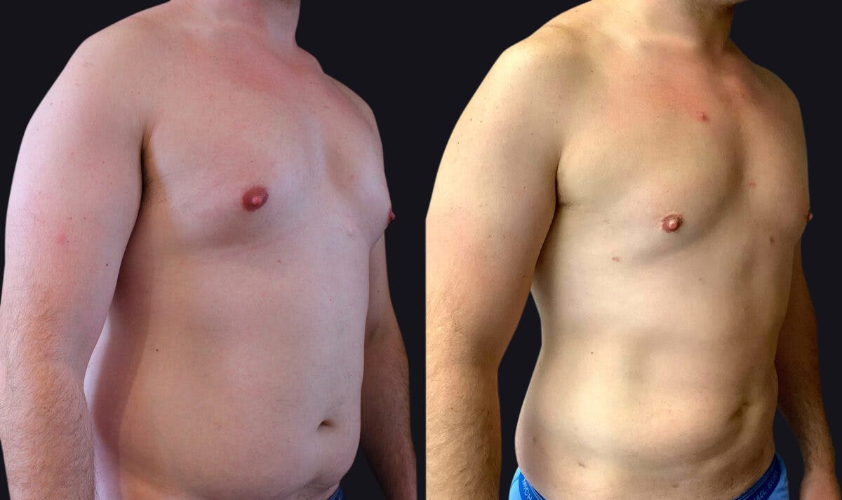 Male Liposuction Before & After Gallery - Patient 177905935 - Image 2