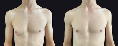 Male Breast Reduction Before & After Gallery - Patient 177905937 - Image 1