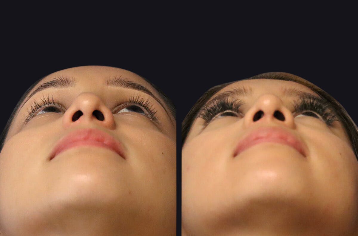 Rhinoplasty Before & After Gallery - Patient 177905934 - Image 10