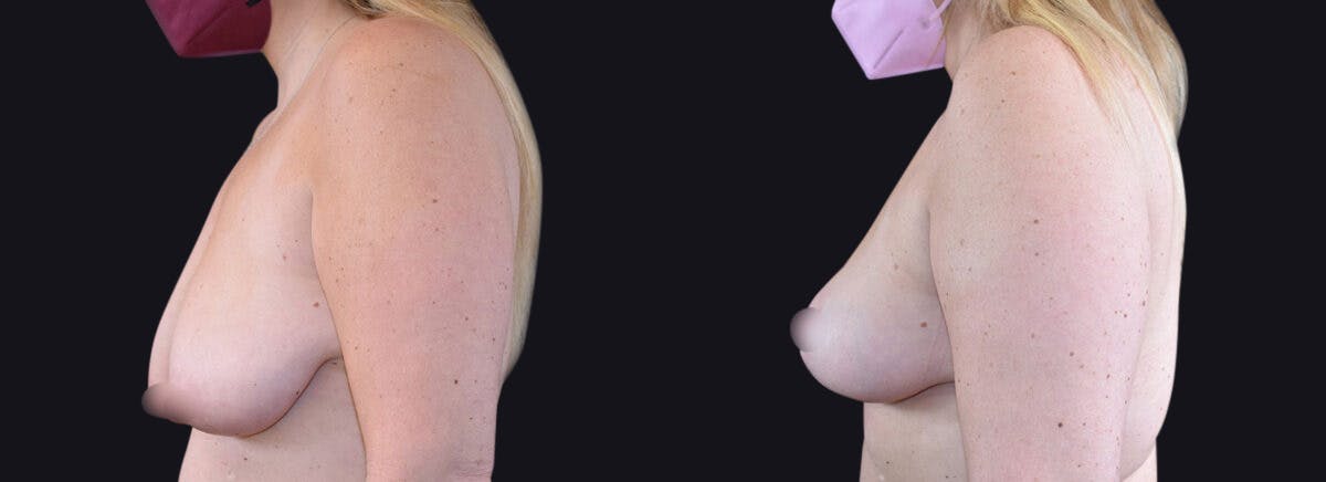 Breast Lift Before & After Gallery - Patient 177905933 - Image 3