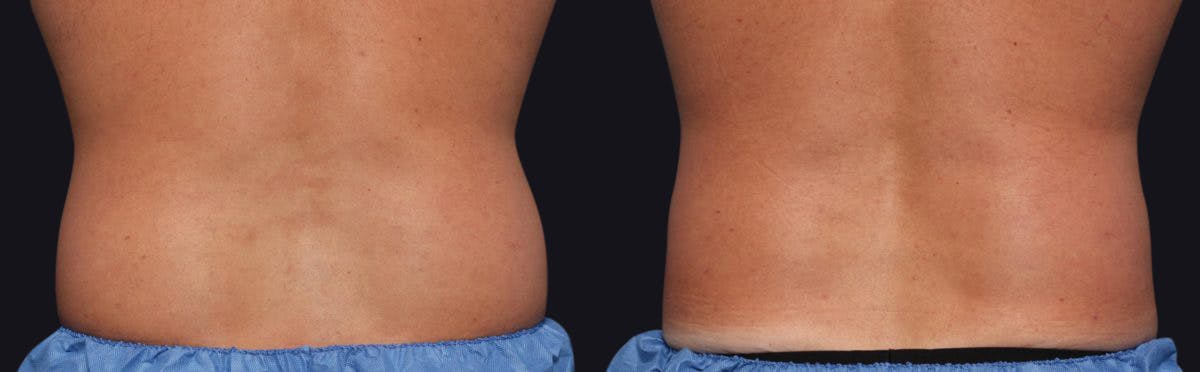 Coolsculpting Before & After Gallery - Patient 177905930 - Image 1