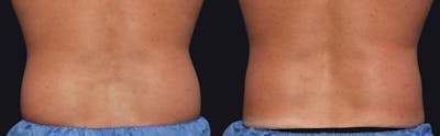 Coolsculpting Before & After Gallery - Patient 177905930 - Image 1