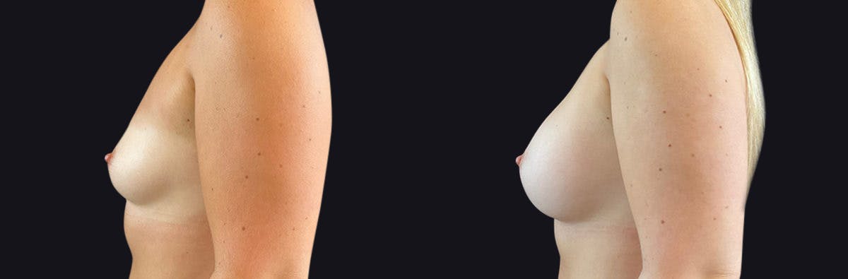 Breast Augmentation Before & After Gallery - Patient 177905931 - Image 3