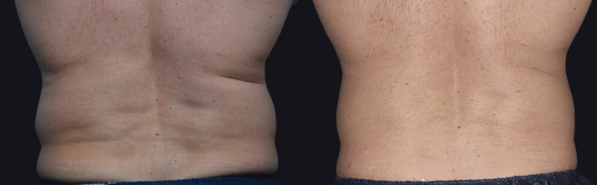 Male Coolsculpting Before & After Gallery - Patient 177905932 - Image 1