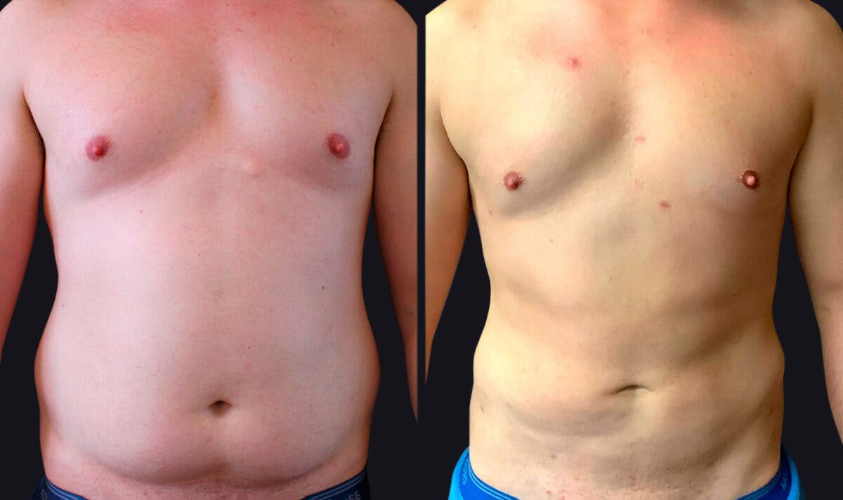 Male Liposuction Before & After Gallery - Patient 177905935 - Image 1