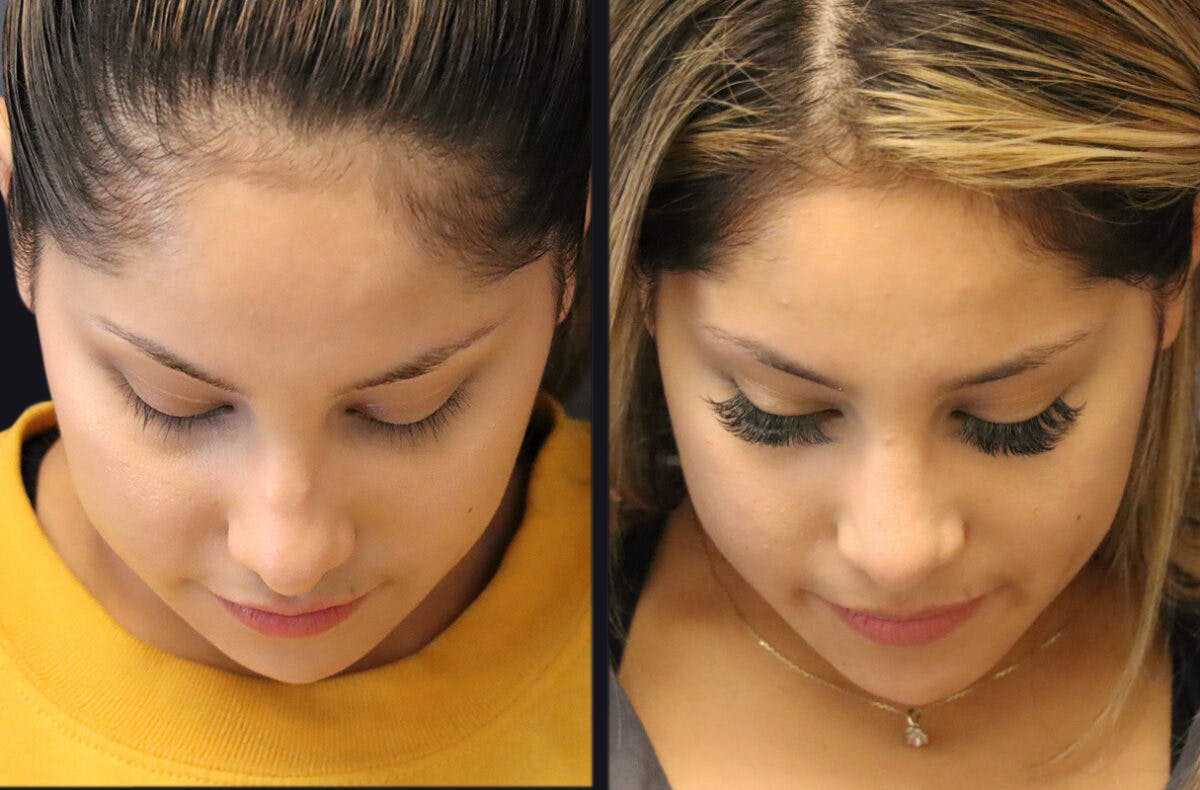 Rhinoplasty Before & After Gallery - Patient 177905934 - Image 9