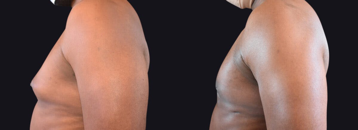 Male Breast Reduction (Gynecomastia) Before & After Gallery - Patient 177905929 - Image 3