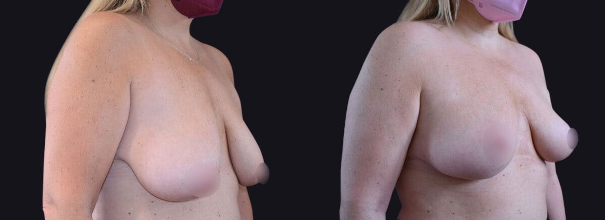 Breast Lift Before & After Gallery - Patient 177905933 - Image 2