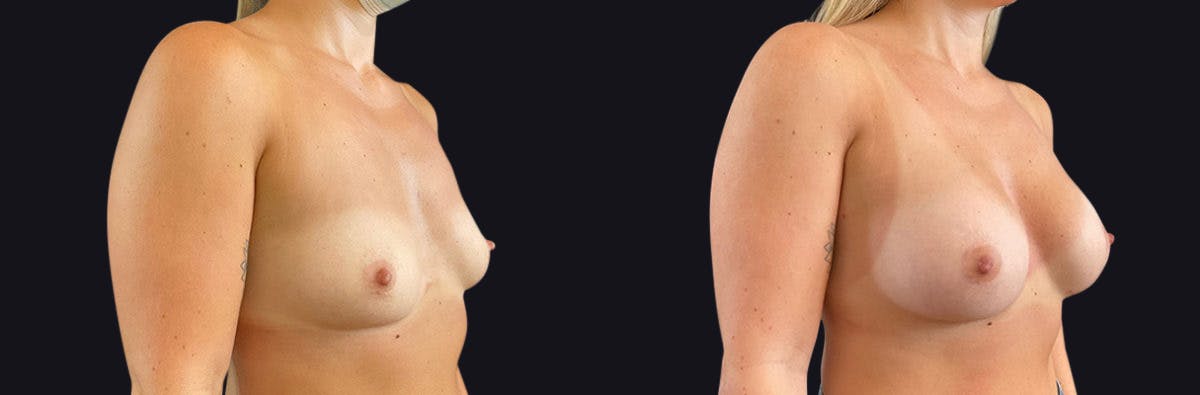 Breast Augmentation Before & After Gallery - Patient 177905931 - Image 2