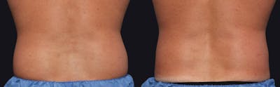 Male Coolsculpting Before & After Gallery - Patient 177905927 - Image 1