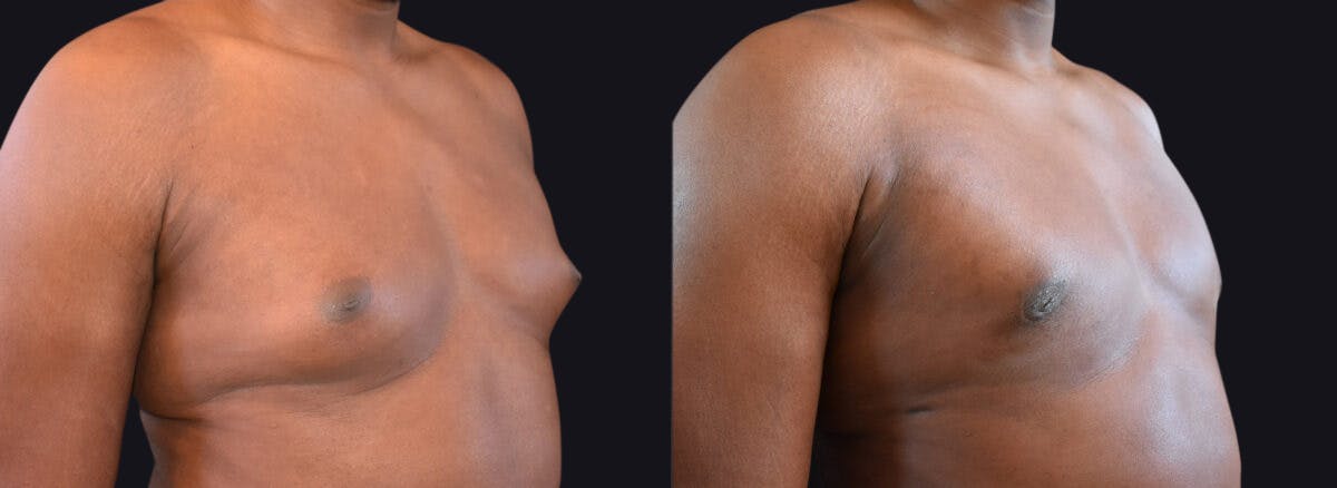 Male Breast Reduction Before & After Gallery - Patient 177905929 - Image 2